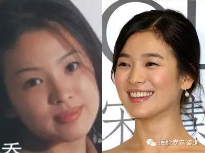 明星整形前后对比照片,揭秘美丽背后的秘密